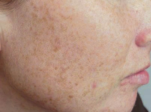 brown-spots-on-the-face