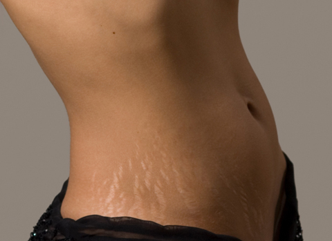 best-stretch-mark-cream