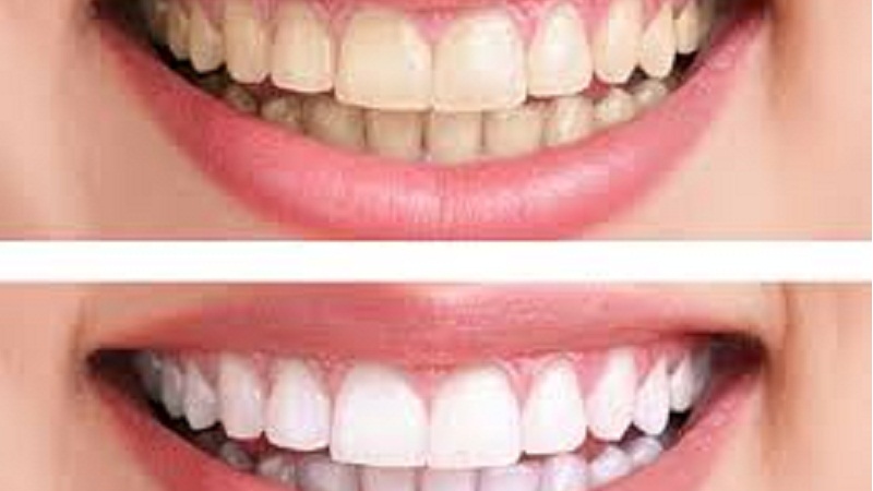 best-teeth-whitening-method