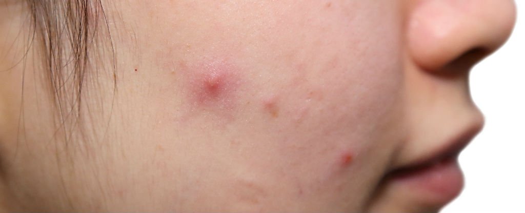 pimples-april_1024